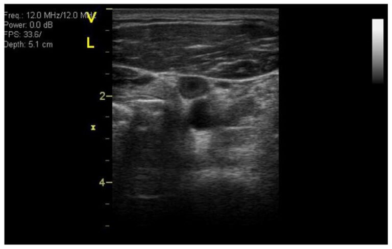 Establishing a VTE Risk Score for Astronauts Algorithm Establishing a VTE Risk Score for Astronauts Algorithm