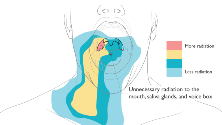 Stentra, an FDA-cleared Custom Mouthpiece for Head and Neck Cancer Radiation Therapy. Image via Kallisio.